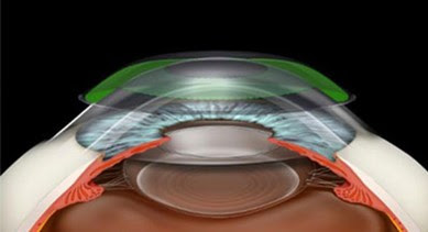 Ortho-k lenses | Orthokeratology Sydney